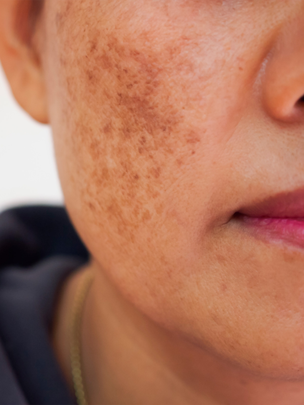 melasma tratamiento