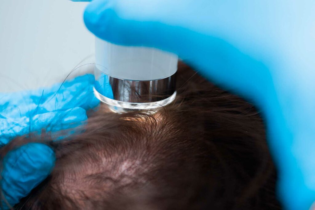 Descubre qué es la tricoscopia y cómo puede ayudarte a mantener un cabello saludable. Aprende sus beneficios y cual es su función en una clínica dermatológica.