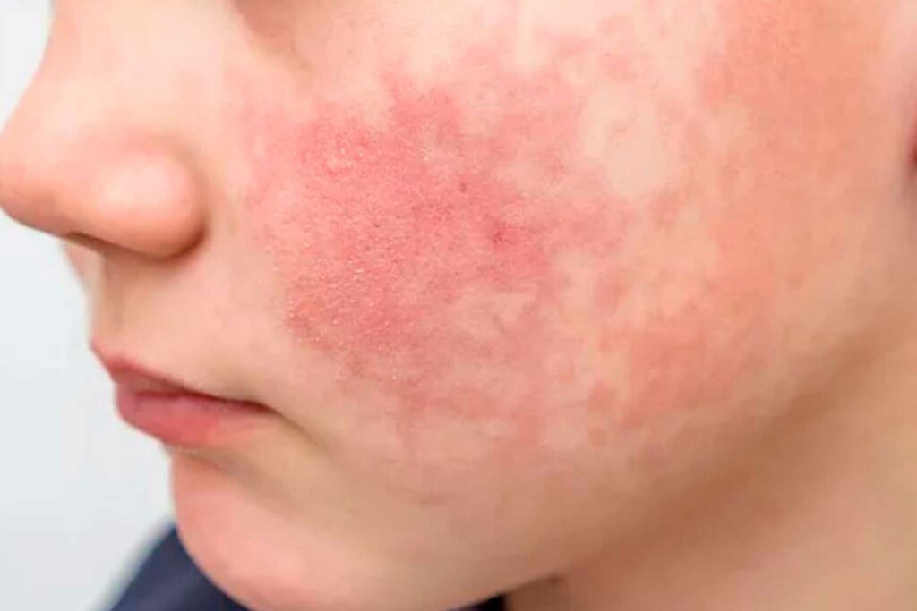 virus de la bofetada