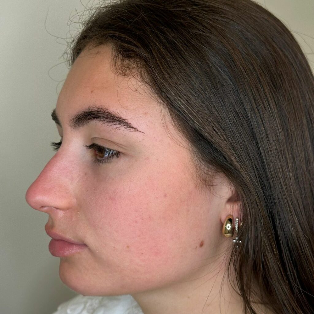 tratamiento para el acne