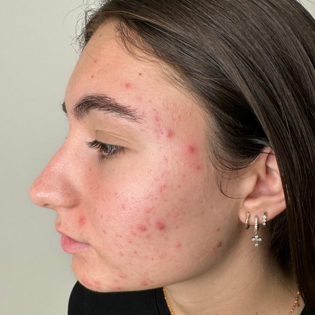 tratamiento para el acne