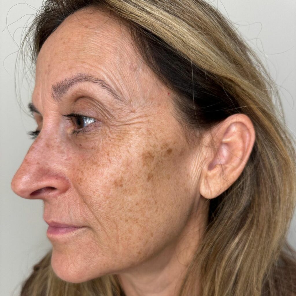 Tratamiento lentigos solares con luz pulsada