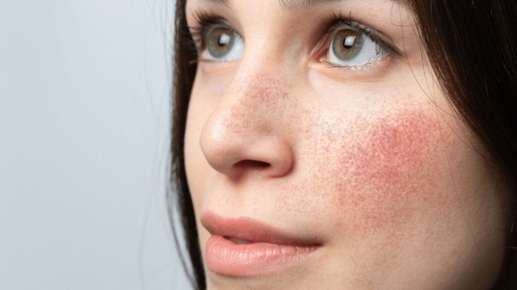 tratamiento ipl para la rosacea
