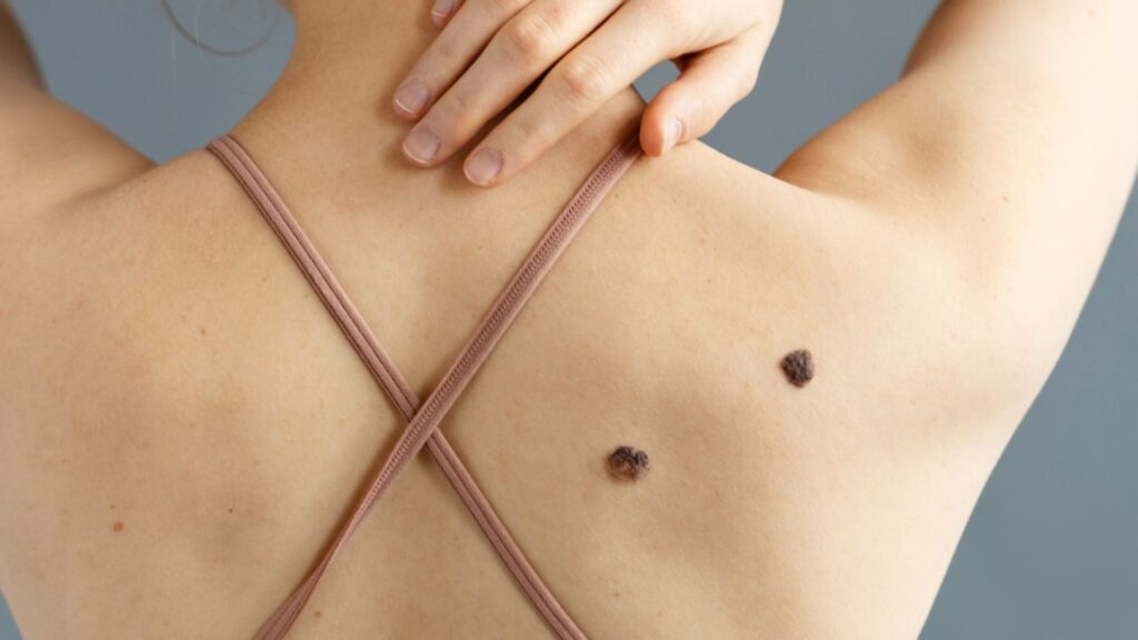 Queratosis seborreicas con láser CO2