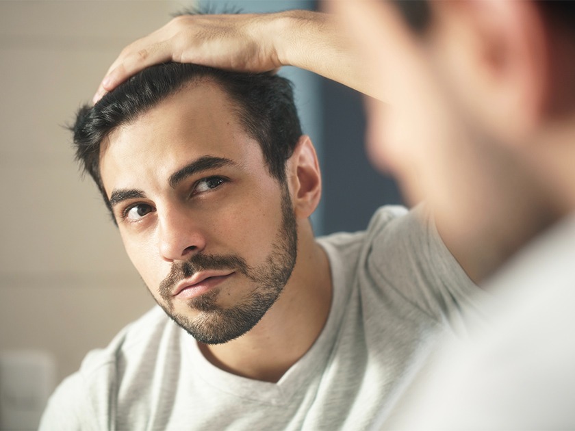 alopecia verano