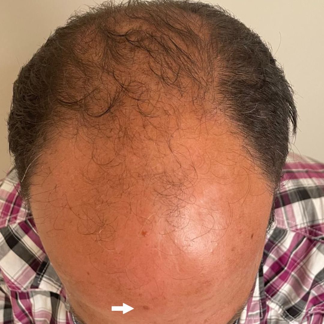 foto de paciente previo a la realización de un trasplante capilar con tecnica FUE