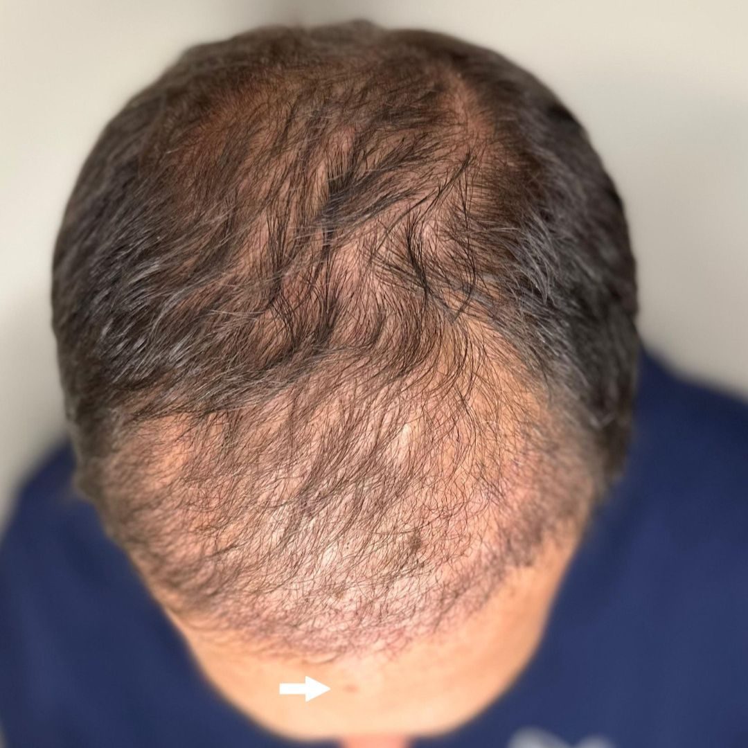Resultado tecnica FUE despues del transplante capilar, paciente real